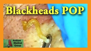 Blackheads POP  Auburn Medical Group [upl. by Lyford]