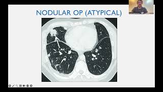 Organizing pneumonia patterns English version [upl. by Schinica879]