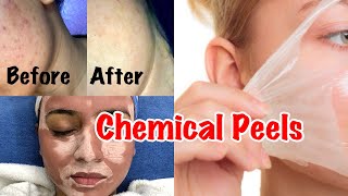 CHEMICAL PEEL TREATMENT  Glycolic Peel Salicylic Peel amp Lactic Peel  Chemical Peels In India [upl. by Garrek114]