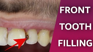 Front Teeth Filling Process  Dentist do front tooth decay repair  Composite bonding restoration [upl. by Otho565]