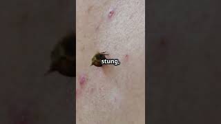 Why Bee Stings Hurt So Much [upl. by Ettellocin]