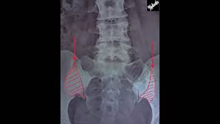 Osteitis Condensans Ilii vs Sacroiliitis [upl. by Anilesor]