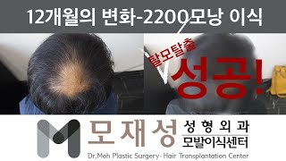 모재성의 탈모탈출 비절개 정수리 교정 1년 비포amp애프터  2200모낭 이식 [upl. by Eahsan]