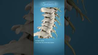 What is Cervical Degenerative Disc Disease Shorts [upl. by Solegnave501]