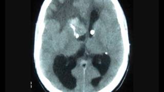 Frontal Intraventricular tumor with hydrocephalus [upl. by Cord]