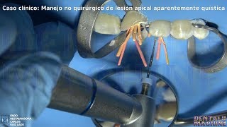 1ra Fase de tratamiento de una lesión apical aparentemente quística Tratamiento de conducto [upl. by Gentes168]