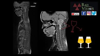 EPENDYMOMA WITH DROP METASTASIS [upl. by Edgar]