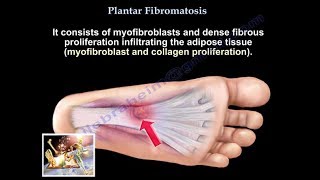 Plantar Fibromatosis  Everything You Need To Know  Dr Nabil Ebraheim [upl. by Atilrahc]