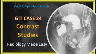 FRCR Radiology  A 58 yrs old patient presented with constipation  GIT Contrast Case 24 [upl. by Atiuqat]