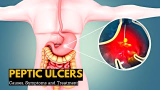 Peptic Ulcers Causes Signs and Symptoms Diagnosis and Treatment [upl. by Malia]