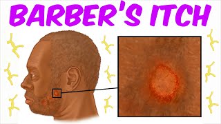 Barbers Itch  A Tinea barbae Infection [upl. by Fahland885]