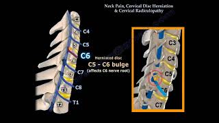 quotNeck Pain Cervical Disc Herniation and Radiculopathy Causes Symptoms and Treatmentquot [upl. by Kassaraba903]