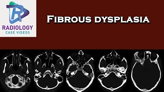 Fibrous dysplasia [upl. by Lipinski]