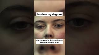 Pendular Nystagmus eyes ophthalmology optometry [upl. by Yhtak]