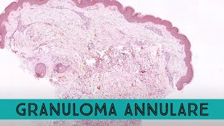 Granuloma annulare under the microscope mimic of ringworm tinea dermatophytosis pathology dermpath [upl. by Manoop]