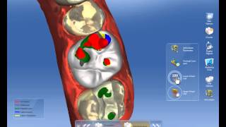 CEREC Software 42  Virtual Articulation [upl. by Clayton348]