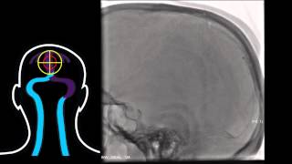 Interventional Stroke Rounds  Venous Sinus Thrombosis [upl. by Ellennad378]