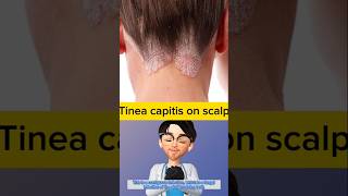 Whats wrong with scalp fungal infection  Doctor explains tinea capitis idoctor [upl. by Son]