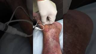 Rapid Healing of Venous Ulcers After Foam Sclerotherapy Treatment [upl. by Jillene]