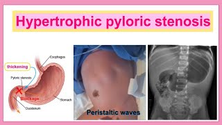 hypertrophic pyloric stenosis [upl. by Beore]