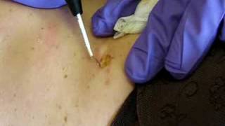 Dorset Somerset Bristol and Southwest England Mole Removal Surgery  cosmetic radiosurgery [upl. by Pimbley]