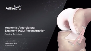 Anatomic Anterolateral Ligament ALL Reconstruction [upl. by Bej]