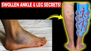 Edema Swollen Feet Swollen Ankles amp Swollen Legs FIX Them FAST [upl. by Adnyc]