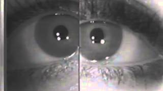 Horners syndrome Dilation Lag [upl. by Wittie]