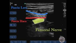 femoral nerve block with labels [upl. by Ashby]