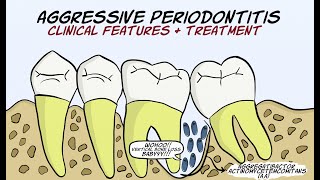 Aggressive Periodontitis Part 2  Clinical features and treatment [upl. by Lello791]