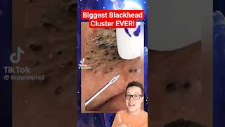 BIGGEST BLACKHEADS REMOVAL EVER  Extreme Blackheads on Cheek shorts [upl. by Onida]