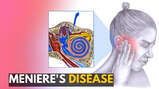 Menieres disease Everything You Need to Know [upl. by Gaskins374]