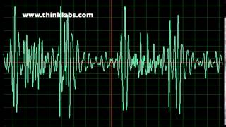 Atrial Septal Defect slow [upl. by Adlanor]