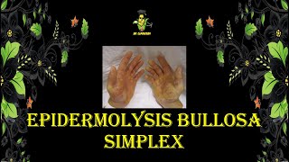 Epidermolysis bullosa simplex  DERMATOLOGY [upl. by Notxarb991]