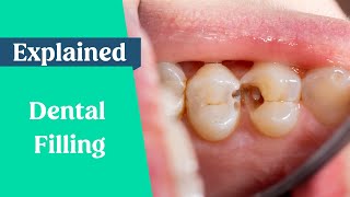 Dental Fillings Explained [upl. by Mcspadden]