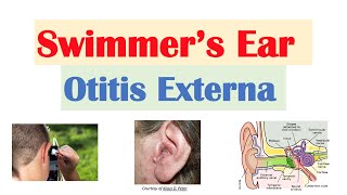 Swimmer’s Ear Otitis Externa  Risk Factors Causes Signs amp Symptoms Diagnosis Treatment [upl. by Ennaus]