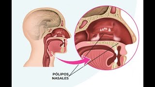 PÓLIPOS NASALES CAUSAS SÍNTOMAS Y TRATAMIENTO [upl. by Annoj]