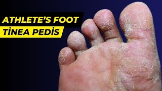 WHAT İS ATHLETE’S FOOTTINEA PEDIS  HEALTH GO [upl. by Akcirederf]