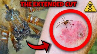 BROWN RECLUSE BITE What happens THE EXTENDED CUT [upl. by Critta100]