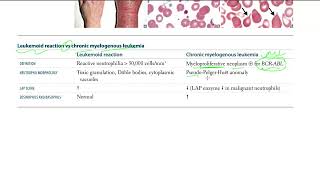 42 Leukemoid reaction vs chronic myelogenous leukemia [upl. by Yrelav]