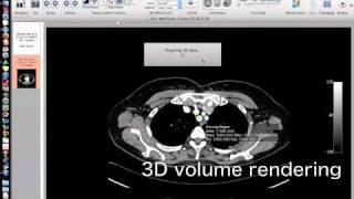 OsiriXsimulated Navigation S1lung segmentectomy [upl. by Ulda22]