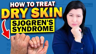 Skin Dryness in Sjogrens Syndrome Patients Treatment Options [upl. by Ellehcen]