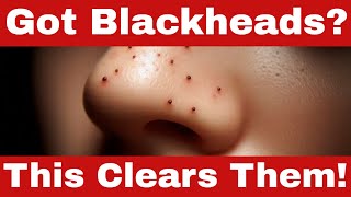 How to Remove Blackheads  Easy Steps for a Clear Skin [upl. by Sirromed]