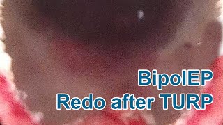 BipolEP  Bipolar Enuclation of the Prostate  Redo case after TURP [upl. by Clotilda]