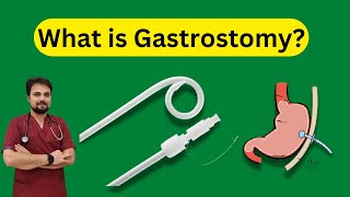 Gastrostomy Tube Insertion  What You Need to Know [upl. by Needan]