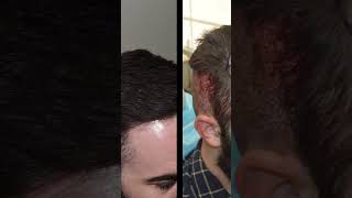 Before and After FUE hair transplant update with 3500 FUEgrafts Natural looking hair transplant [upl. by Krik]