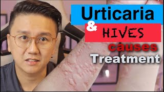 URTICARIA amp HIVES  Causes and Treatment of Itchy Skin Rash [upl. by Kronick]