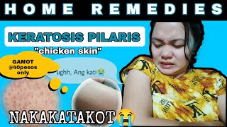 Paano gamutin ang KERATOSIS PILARIS also known as CHICKEN SKINHOME REMEDIES 40PhpTagalogRONA J [upl. by Asiul269]