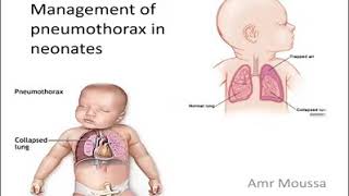 Management of pneumothorax in newborn Dr Amr Moussa Evidence based 2020 [upl. by Meek]