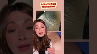 Acanthosis Nigricans AcanthosisNigricans SkinHealth shorts [upl. by Chellman]